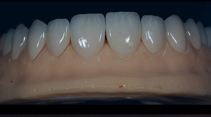 بعد تركيبات-اسنان